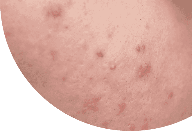 Cara Cepat Samarkan Dark Spot Saat Memasuki Usia 25 Copy Tahun Doremi